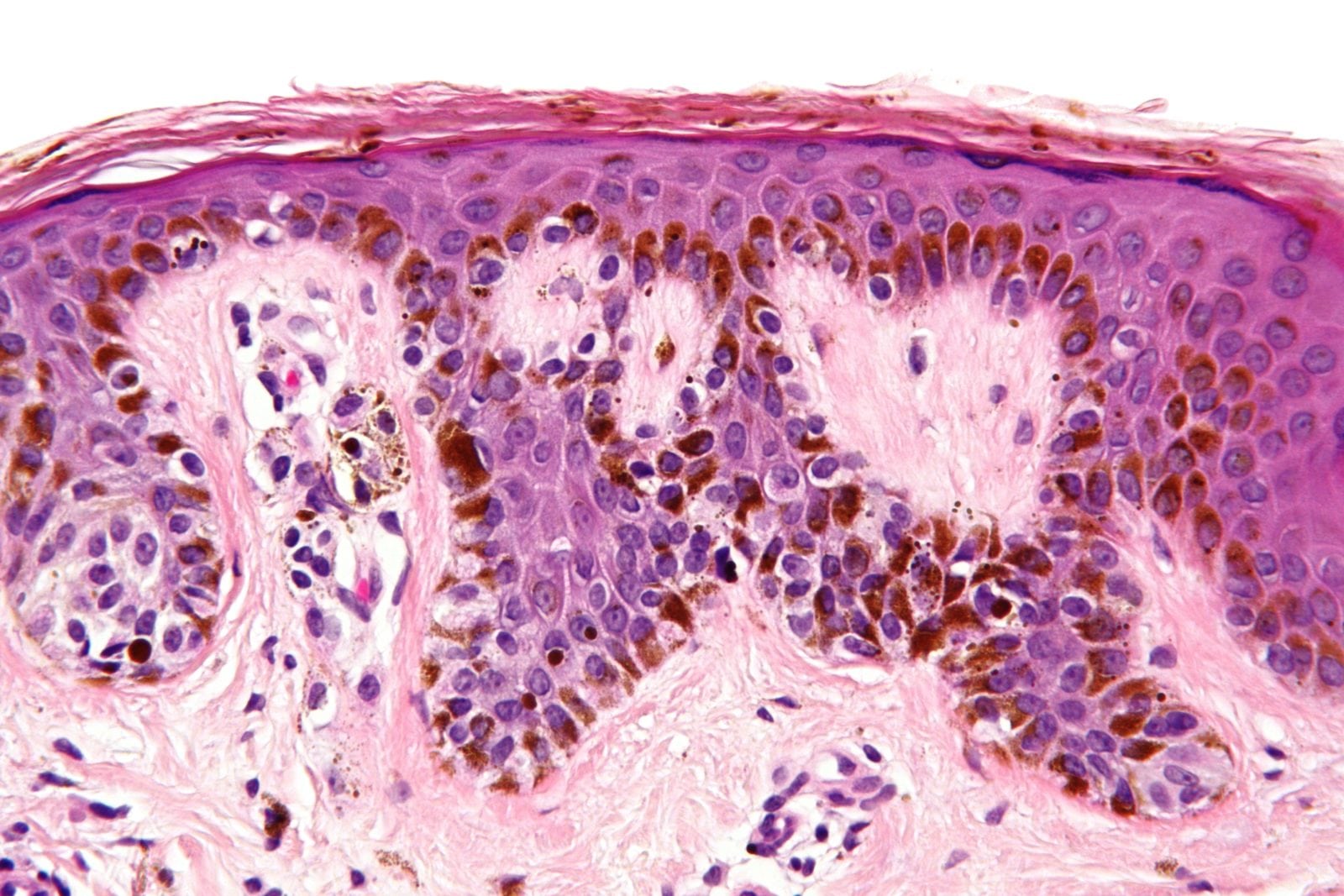 What Does Rare Atypical Cells Mean