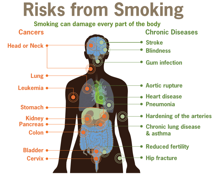 The detailed risks from smoking including cancers and chronic diseases that can occur on each part of your body