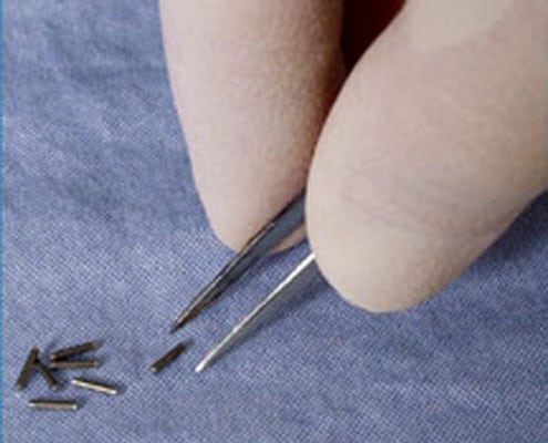 Prostate Cancer Treated With Seed Implants Brachytherapy Shows Paradoxical Utilization Sero