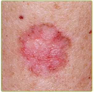 Skin Cancer Basal Cell Carcinoma
