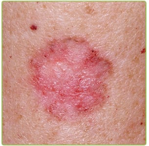 Basal cell carcinoma