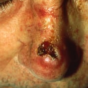 Squamous cell carcinoma on the nose. Public domain.