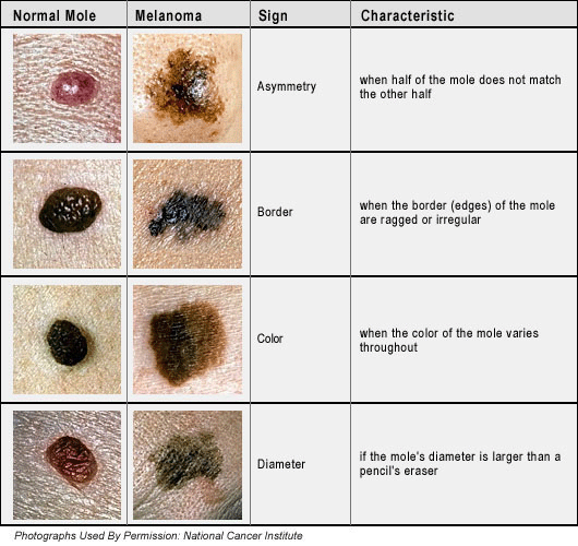 abcd melanoma