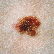 Image of one form of dysplastic nevus/atypical mole. (Photo credit: creative commons)