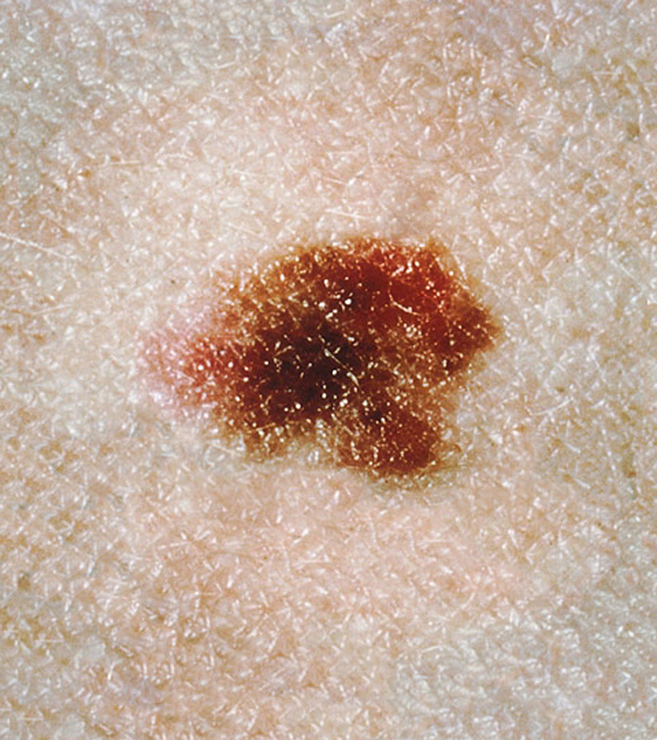 atypical-mole-detection-removal-derrow-dermatology