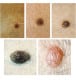 A photo collage of common moles