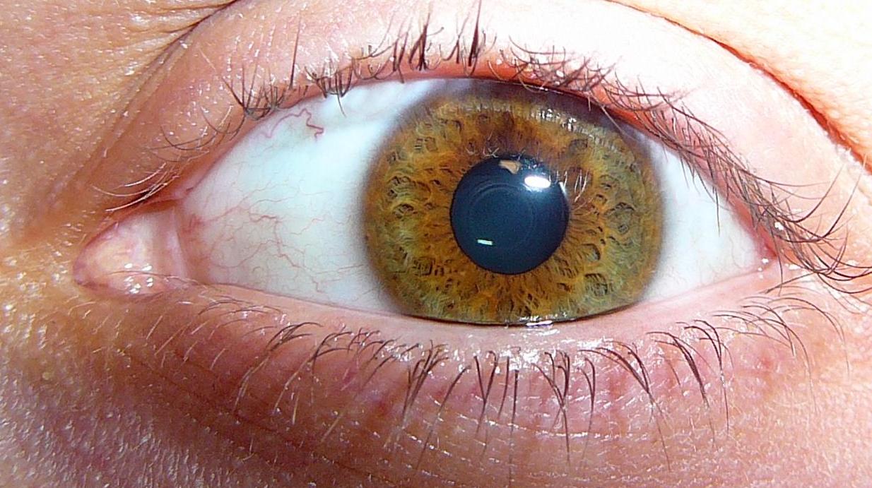 close up of eye with Intraocular (Uveal) Melanoma