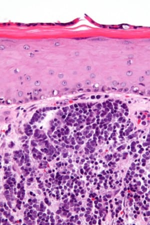 Image of a Merkel Cell Carcinoma under a microscope. (Creative commons image)