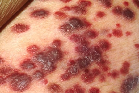 Kaposi sarcoma of the skin. Creative commons image.