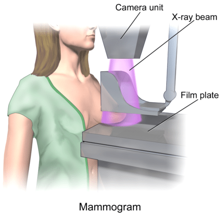 mammogram-breast-cancer