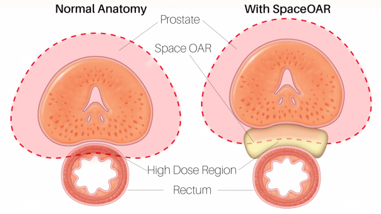 what-you-need-to-know-about-spaceoar-for-prostate-cancer-treatment-sero