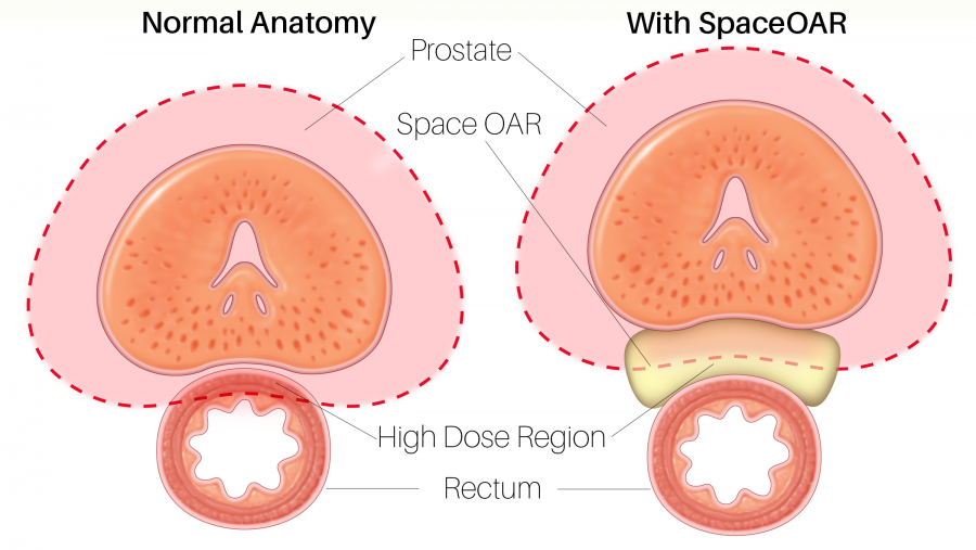 Example of SpaceOAR in a normal anatomy 