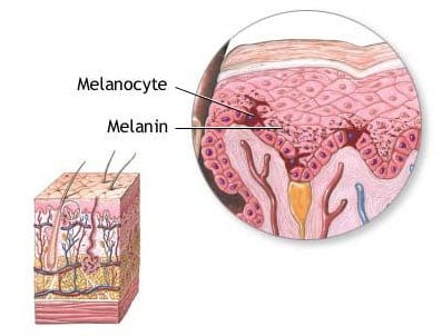 melanoma on skin infographic