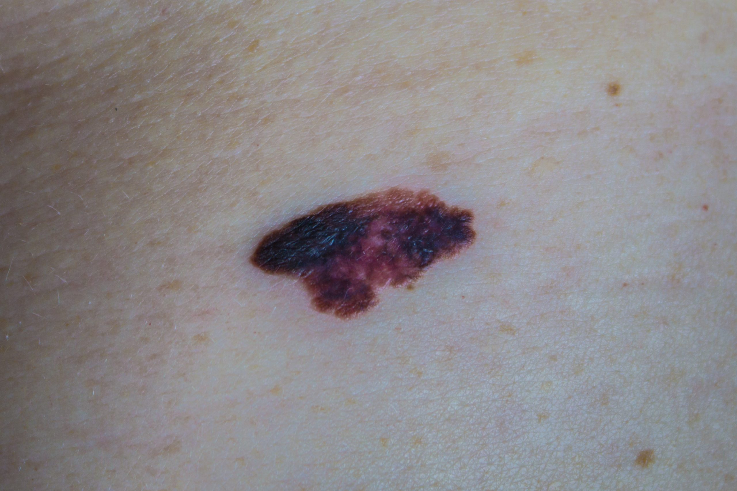 Melanoma on skin
