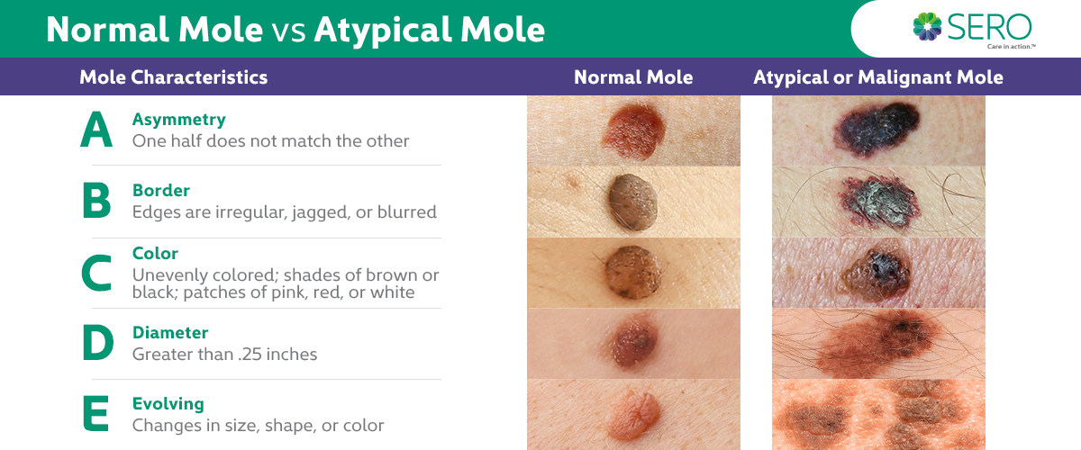 normal mole vs atypical mole infographic