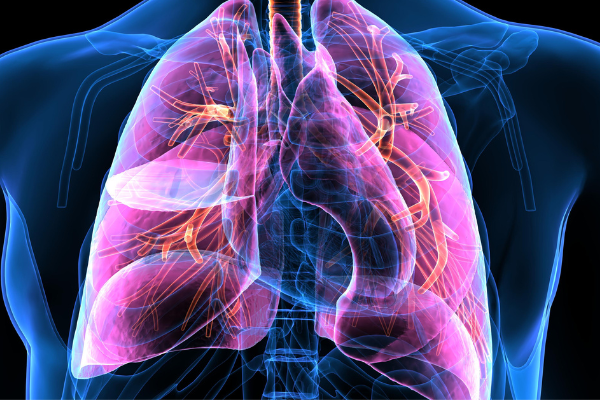 lung scan for cancer