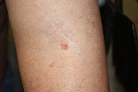Squamous cell carcinoma on skin