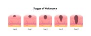 Beginning Stages Of Skin Cancer