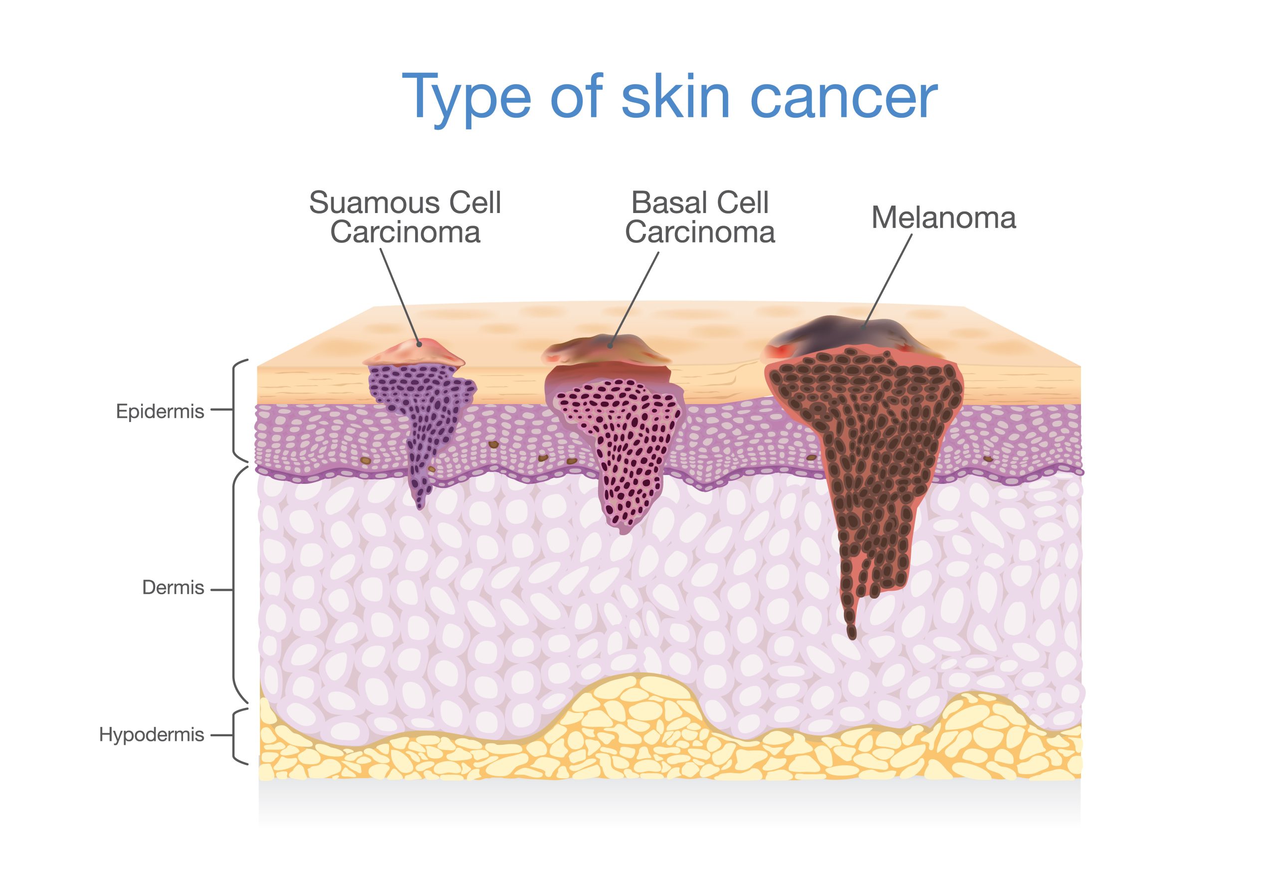 Types of skin cancer infographic