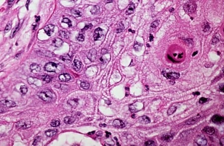 skin cancer cells vs normal cells