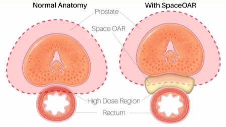 prostate anatomy with SpaceOAR for prostate cancer