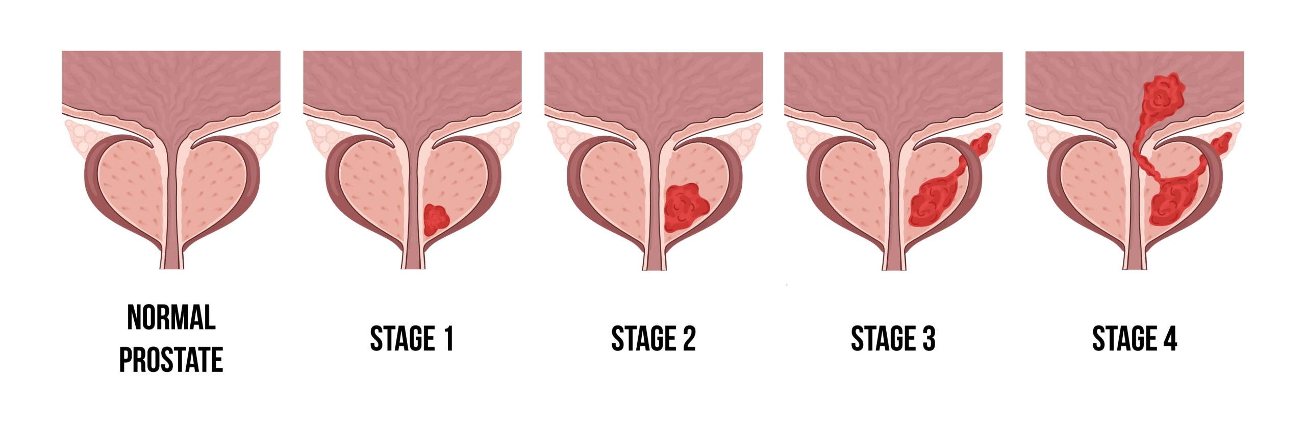 stages of prostate cancer graphic