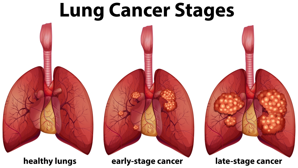 stages of lung cancer infographic